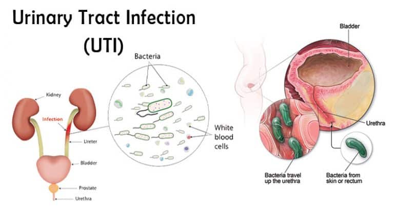 types-of-urinary-tract-infections-symptoms-causes-treatment-sutured