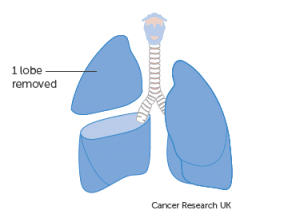 Surgery for Lung Cancer - Risks, Recovery, Survival rate - Sutured