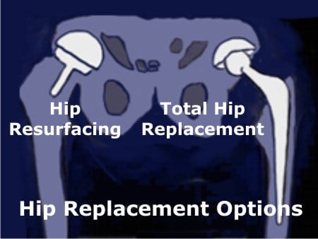 Types of Hip Surgery | Hip Replacement | Hip Resurfacing - Sutured