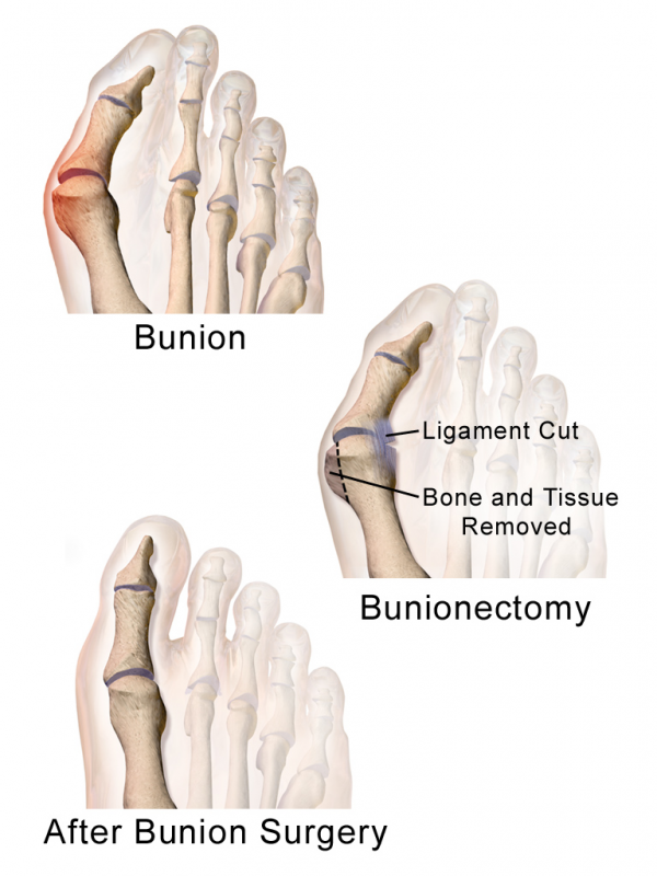 Bunionectomy | Bunion Surgery | Bunionectomy Recovery | Cost - Sutured