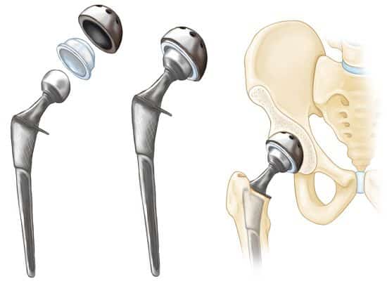 Hemiarthroplasty vs Total Hip Replacement - Sutured