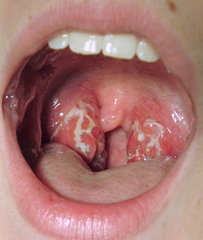 Is it a sore throat or strep? How to tell the difference