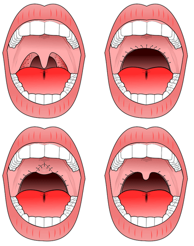 Sleep Apnea Surgery | Sleepa Apnea Treatment | Sleep Surgery - Sutured