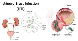 Types of Urinary Tract Infections | Symptoms | Causes | Treatment - Sutured