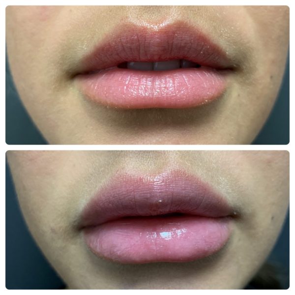 Lip Augmentation Surgery | Risk | Complications | Cost | Before and After