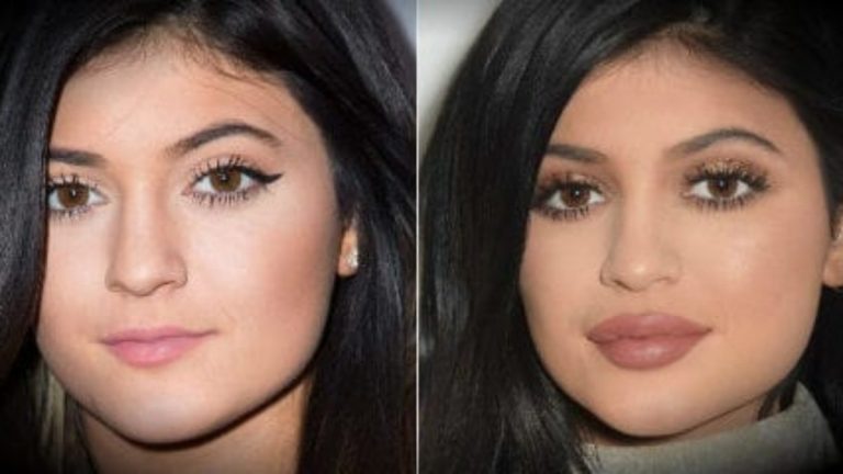 Lip Augmentation Surgery Risk Complications Cost Before And After   Lip Augmentation Before And After 3 768x432 