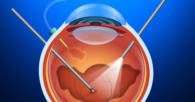 Vitrectomy | Indications | Procedure | Cost - Sutured