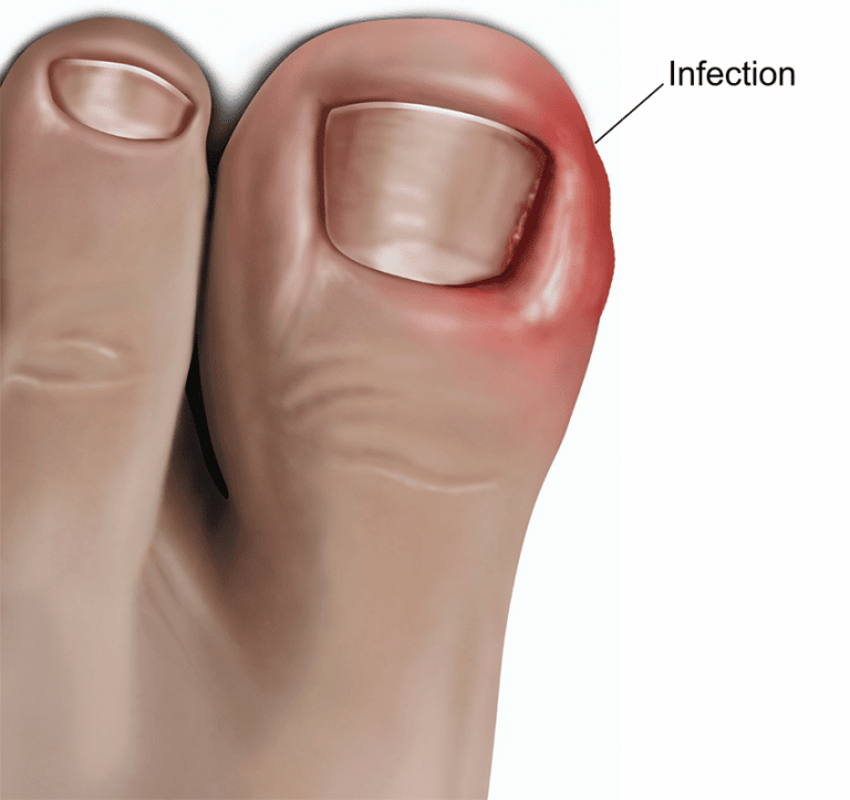 Ingrown Nail Surgery Procedure Cost Sutured