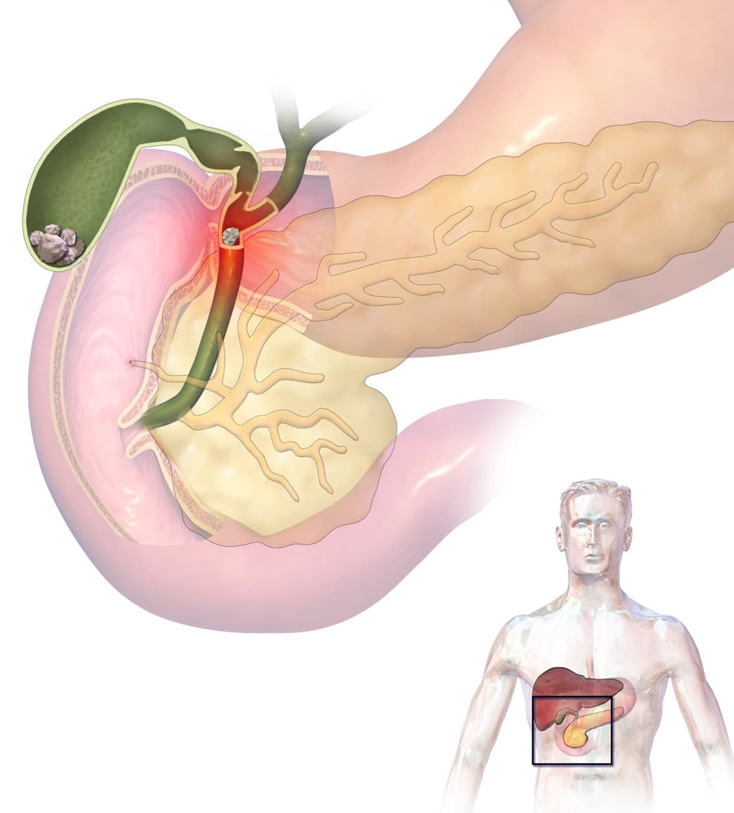 Gallbladder Surgery Recovery Time Sutured