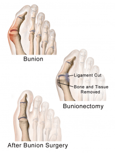 Bunion Surgery Cost | Indications | Procedure - Sutured