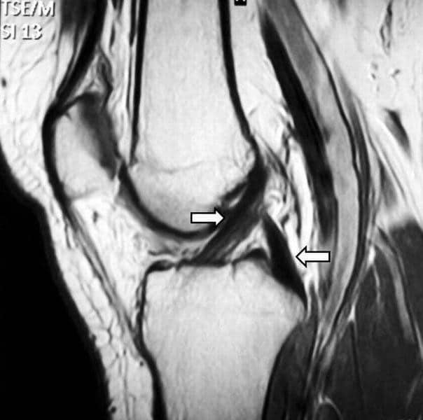 ACL Reconstruction Surgery - Sutured